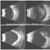 Portable AB Scanner: Ophthalmesch Ultraschall Imaging