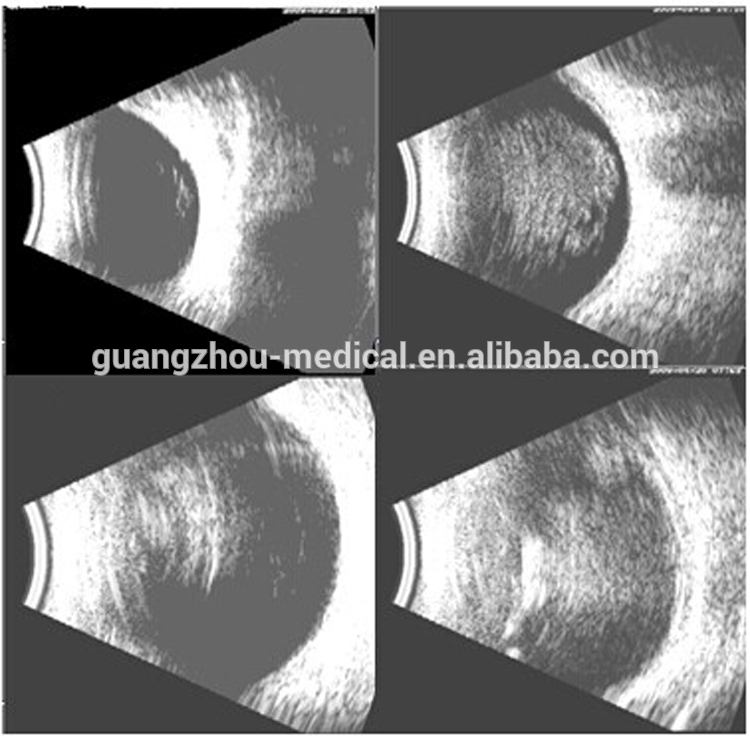 Portable Ophthalmic AB Ultrasound Scanner photos1.jpg