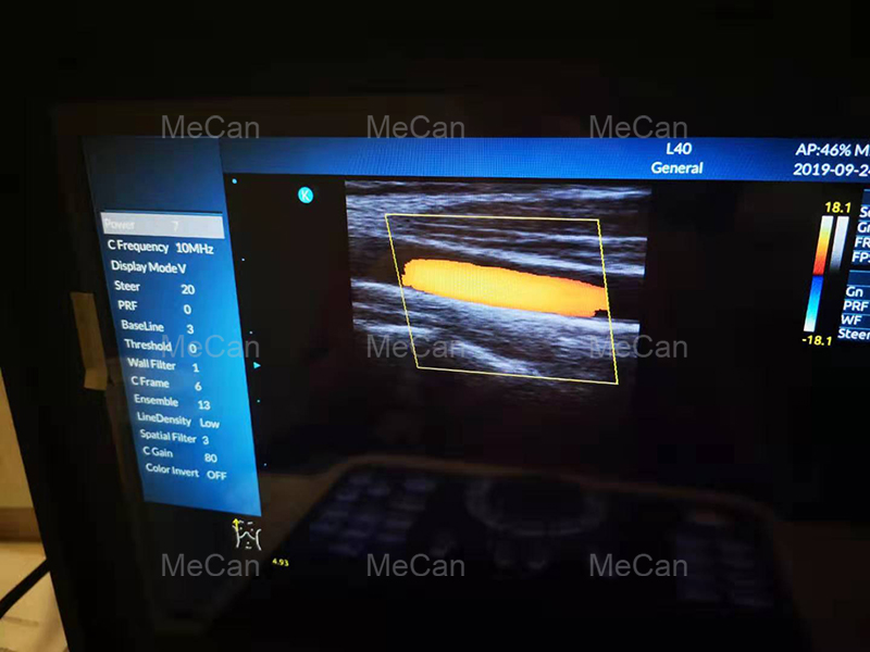 l-immaġni reali tal-Magni Ultrasound Doppler tal-Kulur