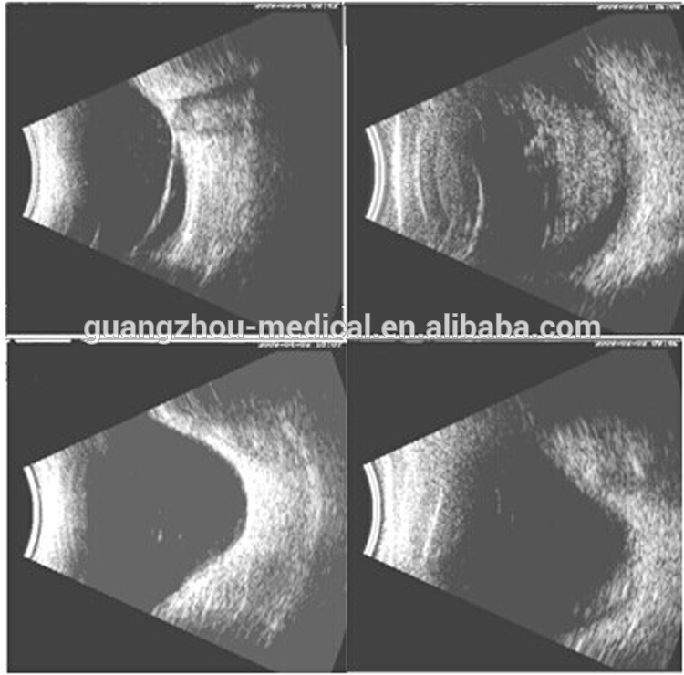 Portable Ophthalmic AB Ultrasound Scanner photos2.jpg