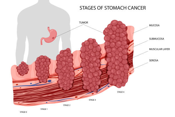 Pochopen&iacute; postupu od prekancer&oacute;zn&iacute;ch l&eacute;z&iacute; k rakovině