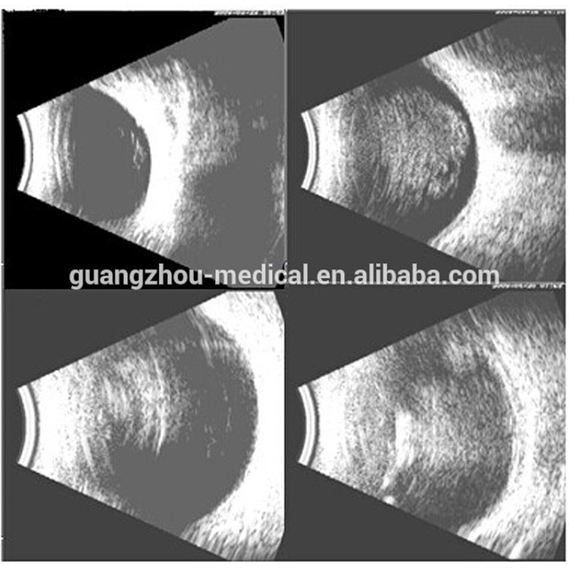 Portable AB Scanner: Ophthalmic Ultrasound Imaging